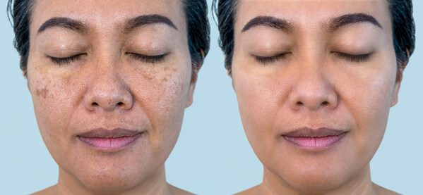 The Australian Photoaging Report shows that Australia has a blind spot when it comes to sun damage and skin health, which has an unexpected mental cost.